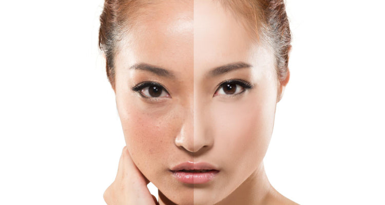Can I Use Retinol After Microneedling?