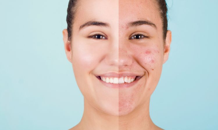 Ordinary Retinol Before Or After Moisturizer